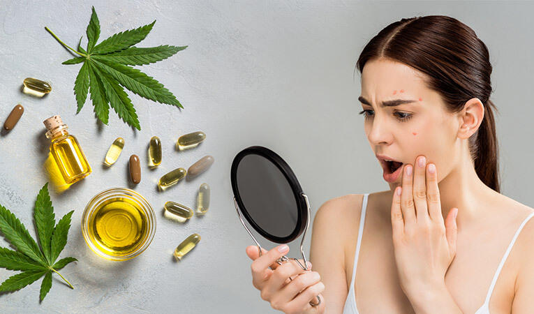 CBD and acne